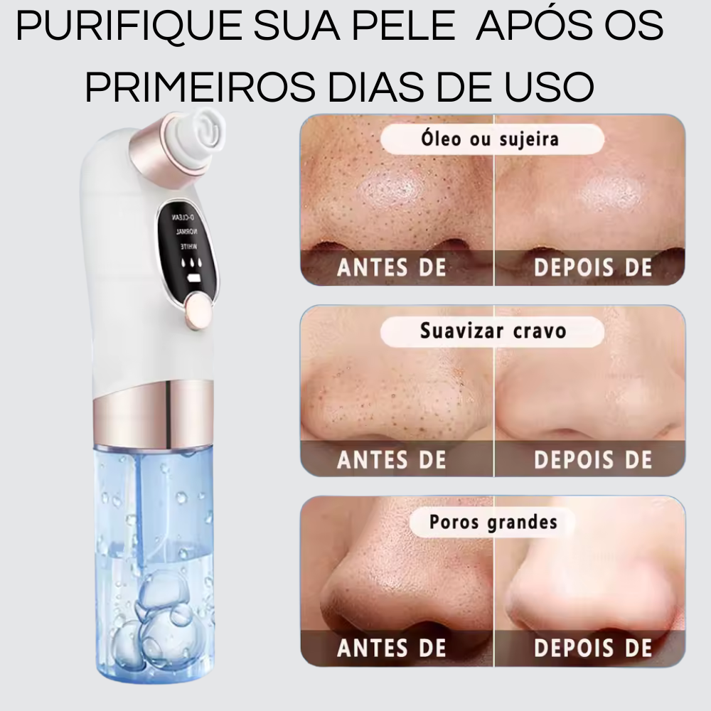 PORECLEAN - remove cravos,espinhas e acnes.