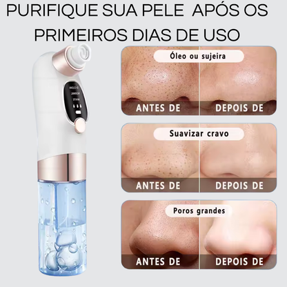 PORECLEAN - remove cravos,espinhas e acnes.