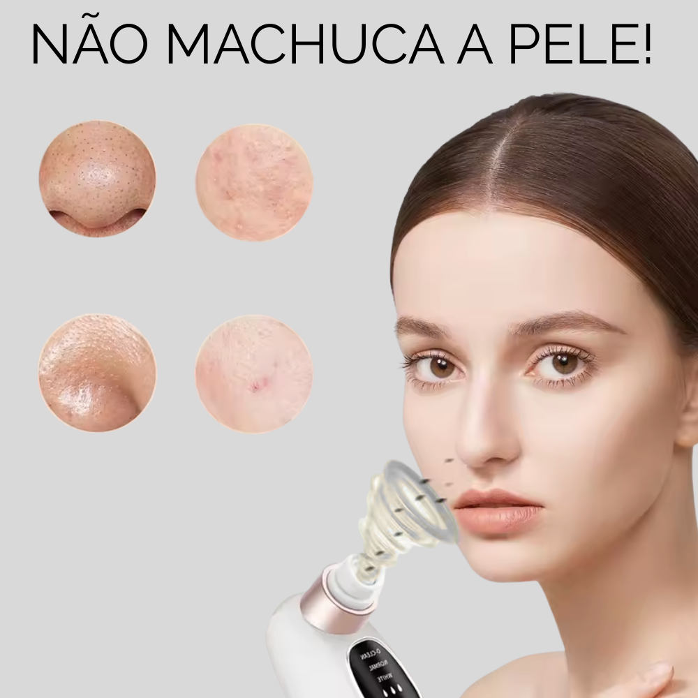 PORECLEAN - remove cravos,espinhas e acnes.